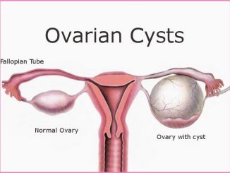 Ovarian Cyst