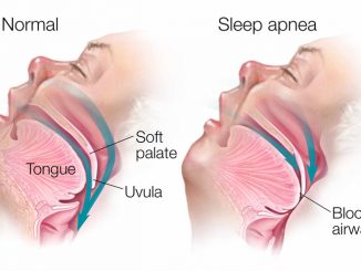 Sleep apnea