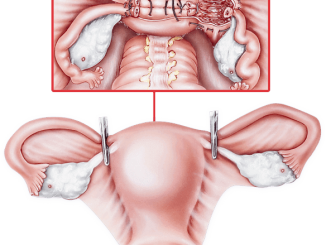 Uterus Removal