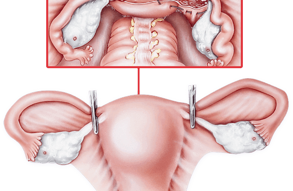 Uterus Removal