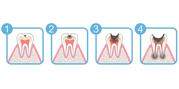 Symptoms of toothh decay