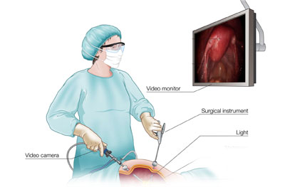 laparoscopic