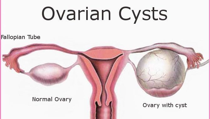 Ovarian Cyst