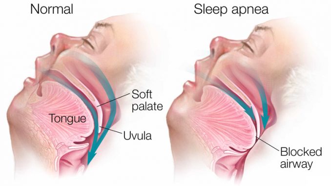 Sleep apnea