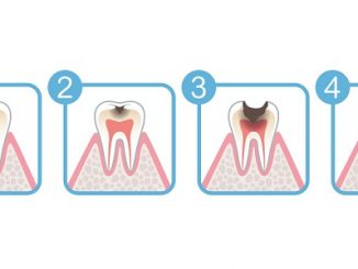 Symptoms of toothh decay